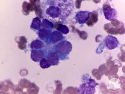 high risk neuroblastoma in bone or bone marrow