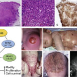 histiocytic neoplasm