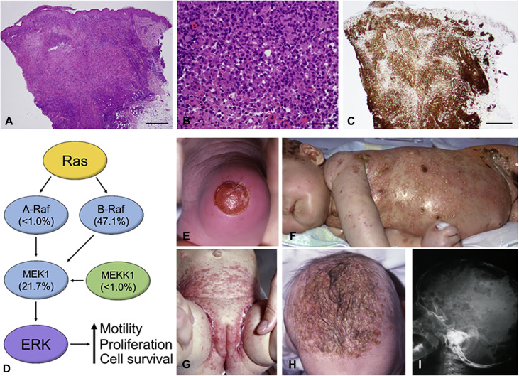 histiocytic neoplasm