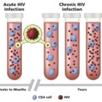 hiv infection