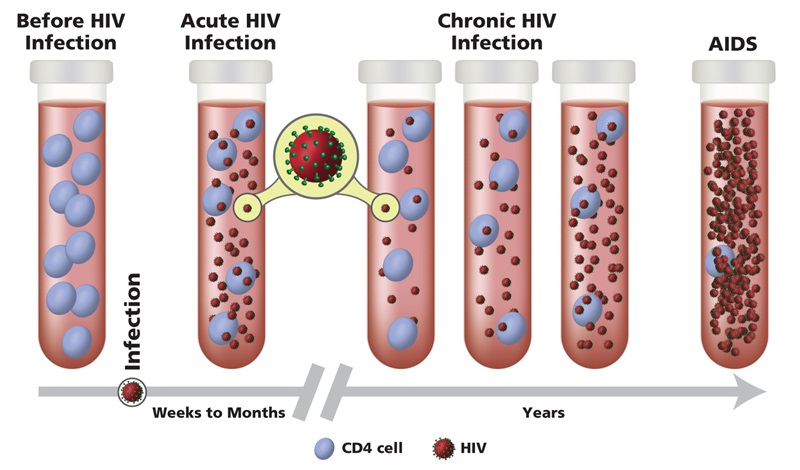 hiv infection