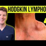 hodgkin's lymphoma