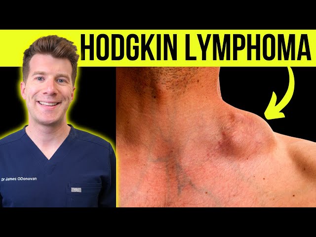 hodgkin's lymphoma