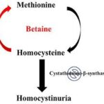 homocystinuria