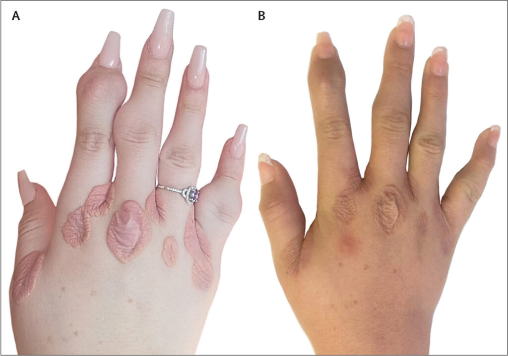 homozygous familial hypercholesterolemia