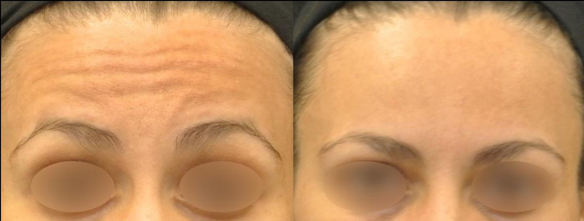 horizontal forehead lines