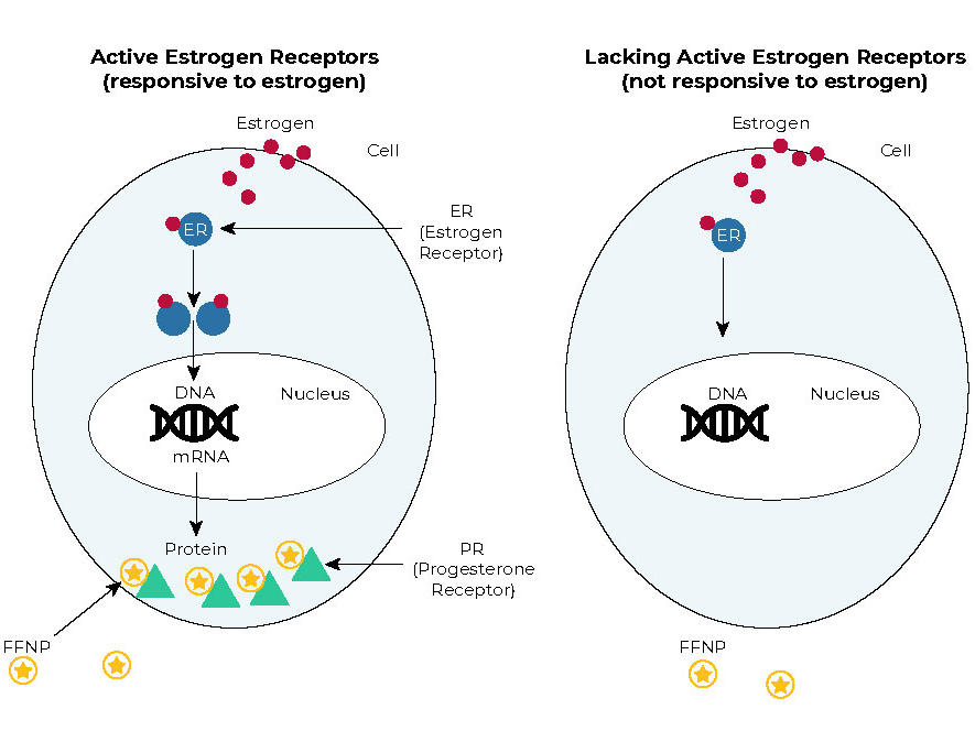 hormone receptor positive breast cancer