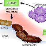 humoral hypercalcemia of malignancy