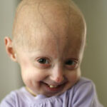 hutchinson-gilford progeria syndrome