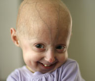 hutchinson-gilford progeria syndrome