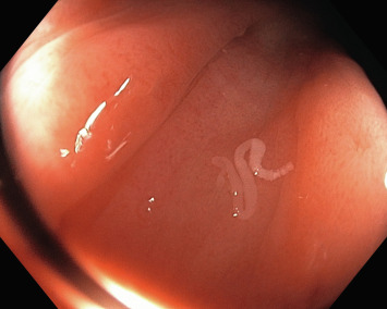 hymenolepiasis infection