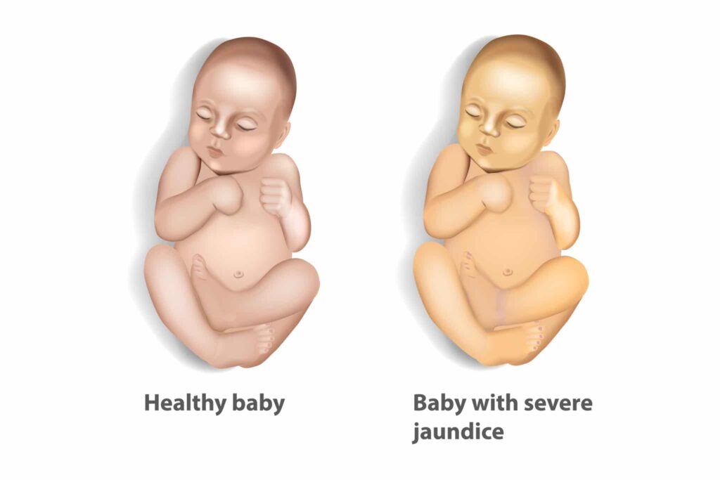 hyperbilirubinemia due to hemolytic disease of newborn