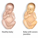 hyperbilirubinemia due to hemolytic disease of newborn