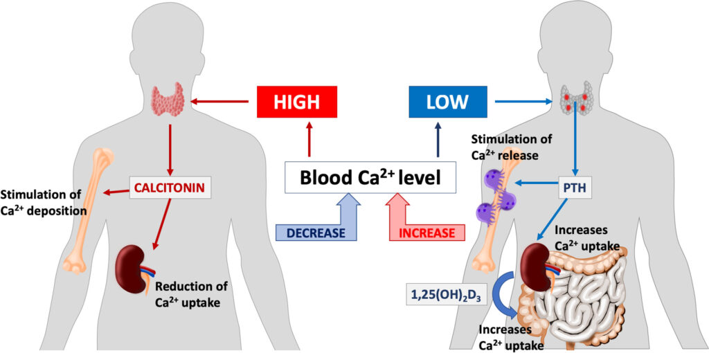 hypercalcemia associated with sarcoidosis