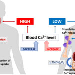 hypercalcemia associated with sarcoidosis