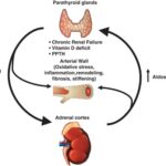 hypercalcemia due to primary hyperparathyroidism