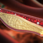 hypercholesterolemia