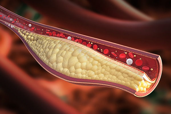 hypercholesterolemia