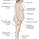 hypercortisolism