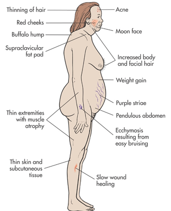 hypercortisolism