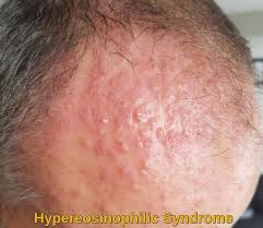 hypereosinophilic syndrome