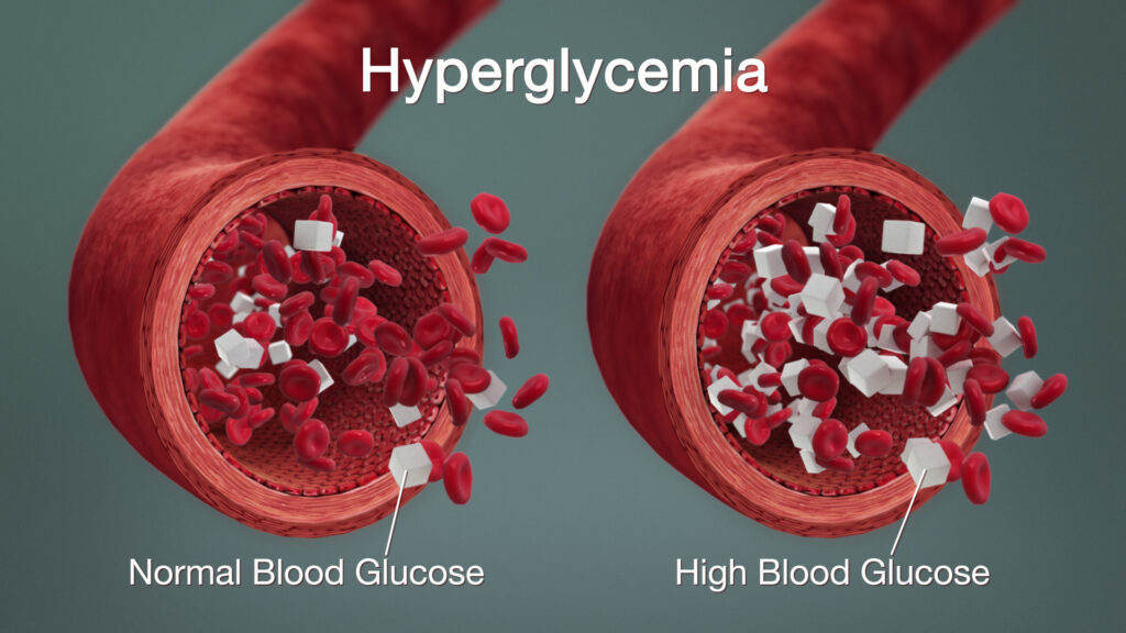 hyperglycemia