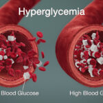 hyperglycemia