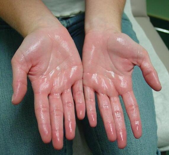 hyperhidrosis