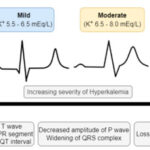 hyperkalemia