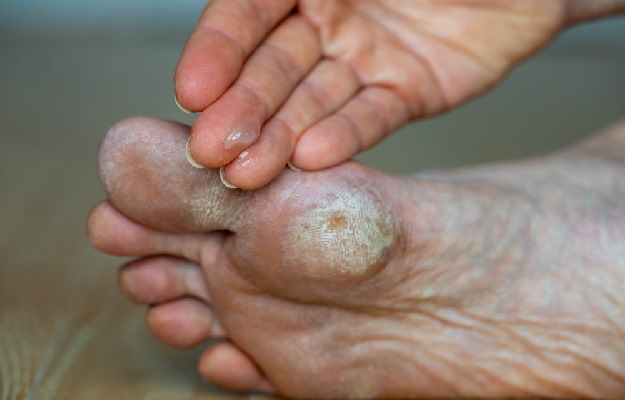 hyperkeratosis