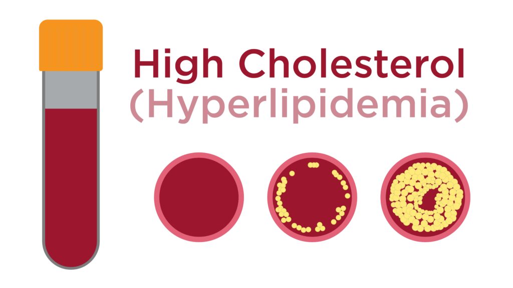 hyperlipidemia