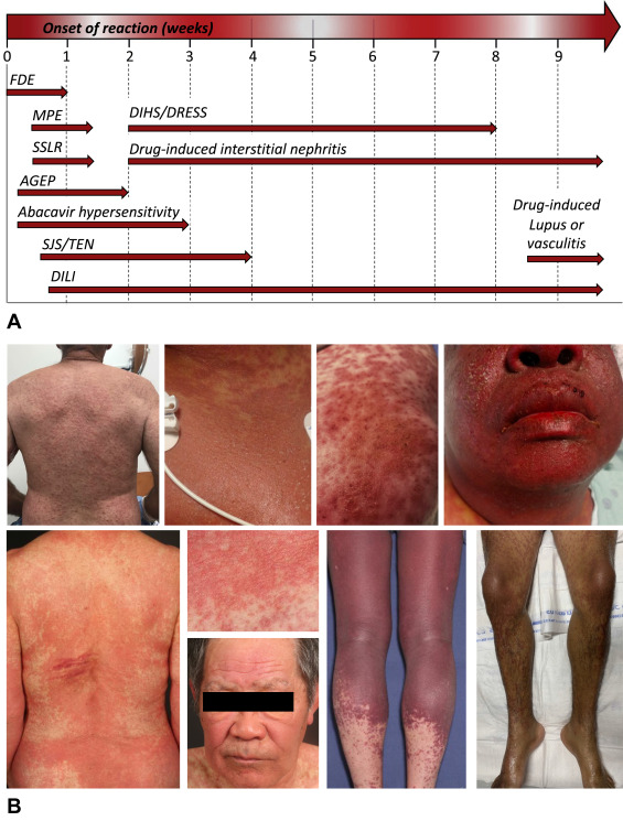 hypersensitivity drug reaction