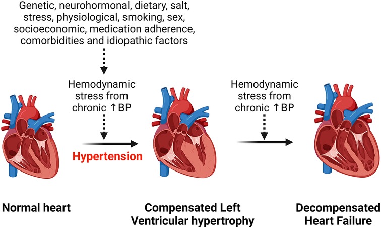 hypertension with left ventricular hypertrophy