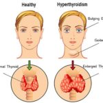 hyperthyroidism