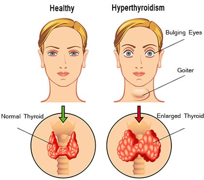 hyperthyroidism