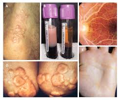 hypertriglyceridemia