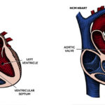 hypertrophic cardiomyopathy