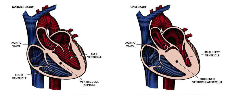 hypertrophic cardiomyopathy