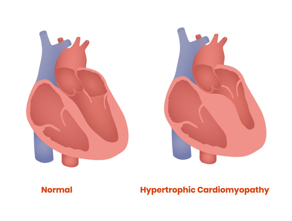 hypertrophic obstructive cardiomyopathy