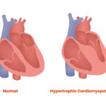 hypertrophic obstructive cardiomyopathy