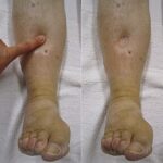 hypoalbuminemia