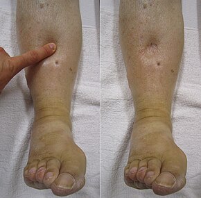 hypoalbuminemia