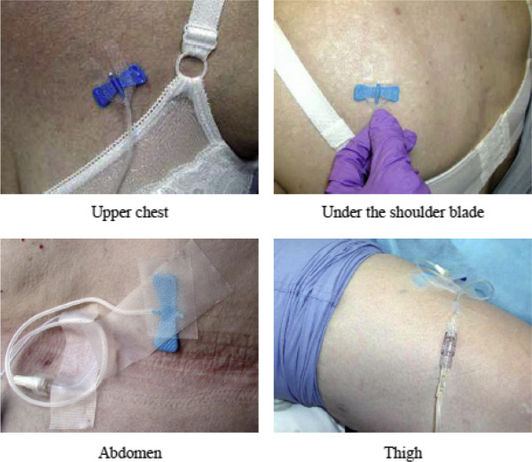 hypodermoclysis