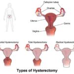 hypoestrogenism due to bilateral oophorectomy