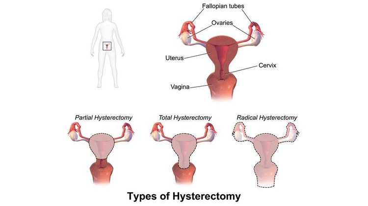 hypoestrogenism due to bilateral oophorectomy