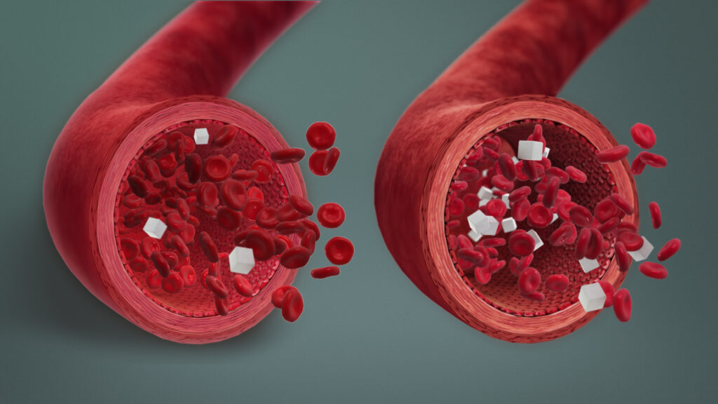 hypoglycemic disorder