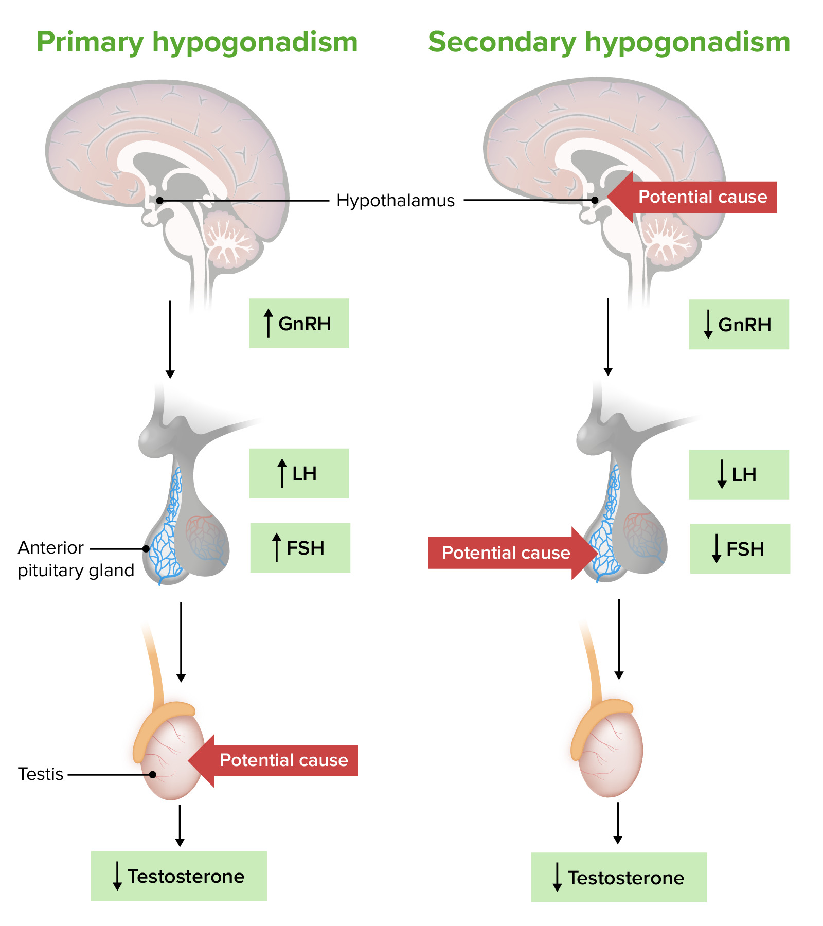 hypogonadotropic hypogonadism