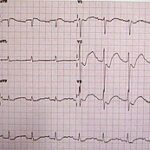 hypokalemia