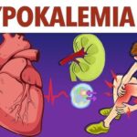 hypokalemia prevention