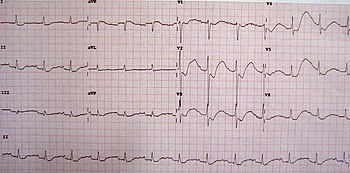 hypokalemia